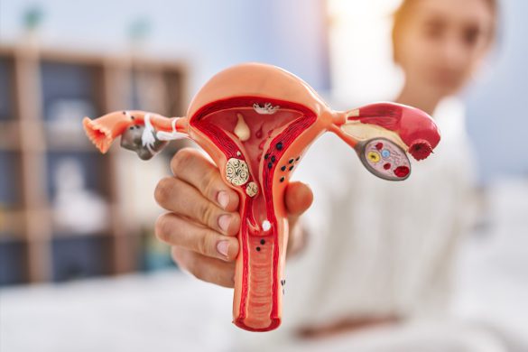 ODKRYWANIE TAJEMNIC ENDOMETRIOZY: ZROZUMIENIE, DIAGNOSTYKA I PERSPEKTYWY TERAPEUTYCZNE